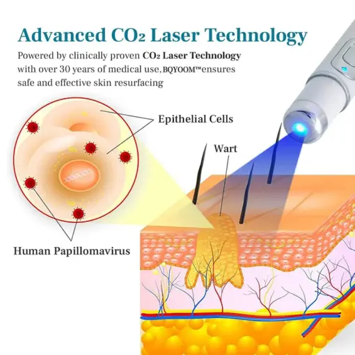 BQYOOM™ FlawZapper Mole and Wart Removal Laser Pen - Image 5