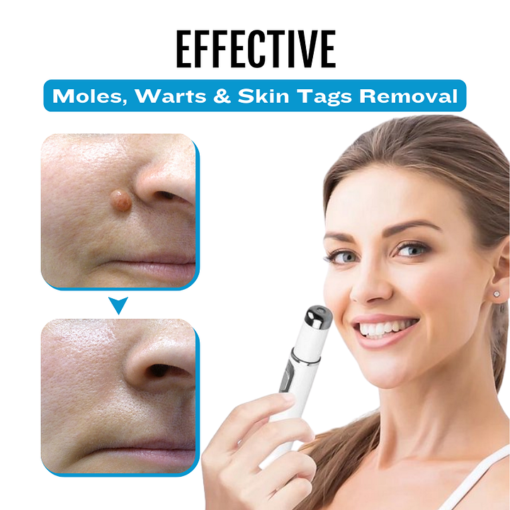 BQYOOM™ SpotlessDerm Mole and Wart Laser Pen - Image 5