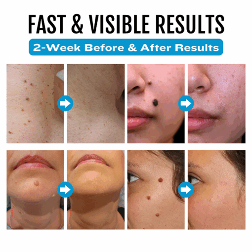 BQYOOM™ SpotlessDerm Mole and Wart Laser Pen - Image 4