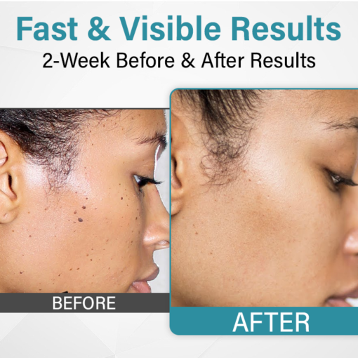 BQYOOM™ MoleLaser Painless Laser Mole Removal Pen - Image 2