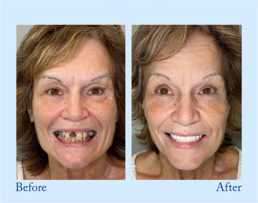 BQYOOM™ Advanced 3D Custom Dentures - Image 4