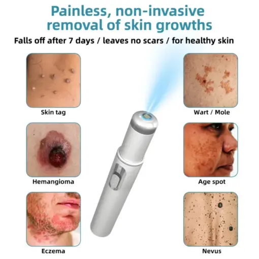 BQYOOM™ Non-Invasive Mole and Wart Removal Laser Pen - Image 2