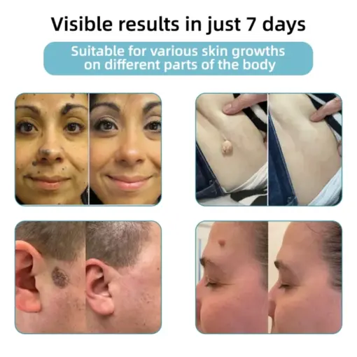 BQYOOM™ Non-Invasive Mole and Wart Removal Laser Pen - Image 3