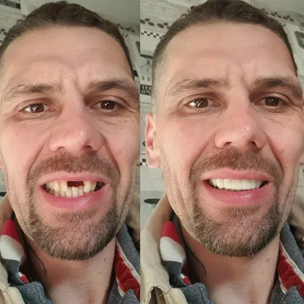 BQYOOM™ -Advanced Custom-Fit Functional Dentures - Image 3