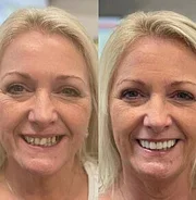 BQYOOM™ -Advanced Custom-Fit Functional Dentures - Image 4